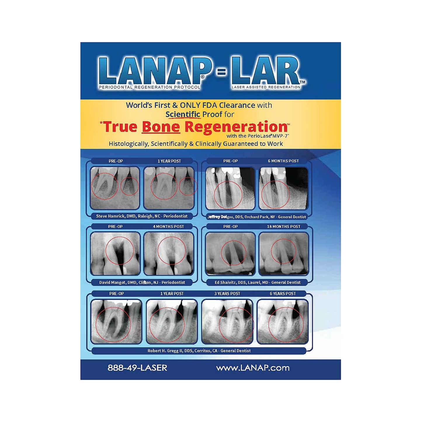 LANAP® Success Brochure - 25pk
