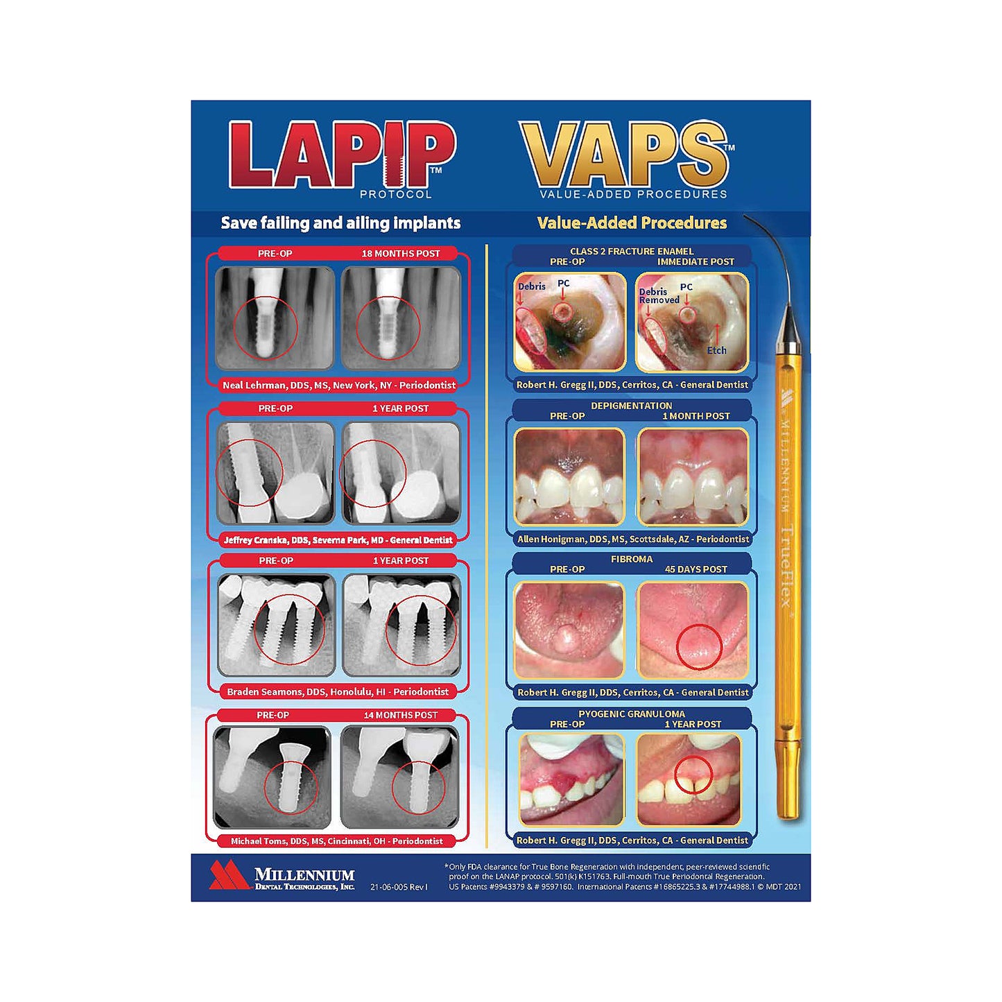 LANAP® Success Brochure - 25pk