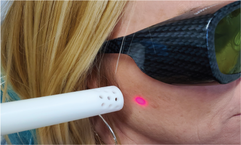 Biostimulation Handpiece with Collet