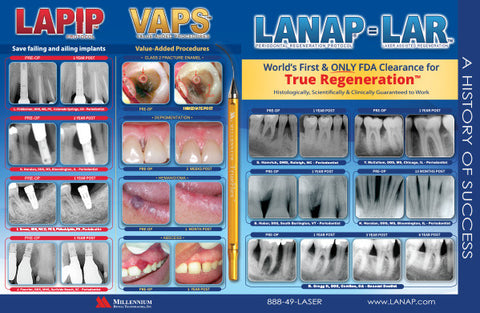 Prints - LANAP® Success Brochure - Qty 25