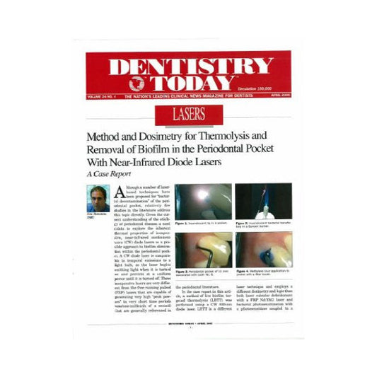 Reprint - Method and Dosimetry for Thermolysis and Removal of Biofilm in the Periodontal Pocket with Near Infrared Diode Lasers - Dentistry Today - 25pk